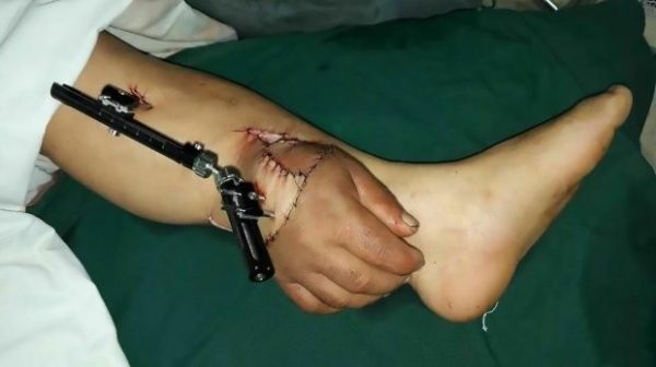 Китайские хирурги спасли оторванную руку мужчины, пришив её к ноге