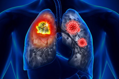 Коронавирус и рак легких: как отличить симптомы