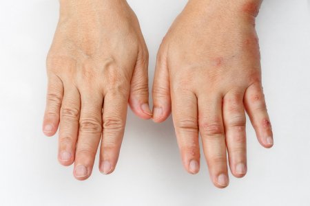Вплоть до рака: кардиолог рассказал об опасности отекших рук