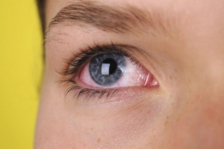 Из-за какой болезни белки глаз меняют цвет: офтальмолог