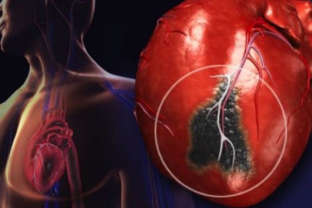 Предвестник инфаркта: без чего не начнется атеросклероз